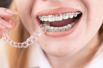 Dental Care.smiling Girl With Braces On Her Teeth Holds Aligners In Her Hands And Shows The Difference Between Them