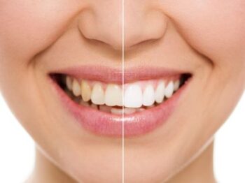 Teeth Whitening Lake Oswego Or